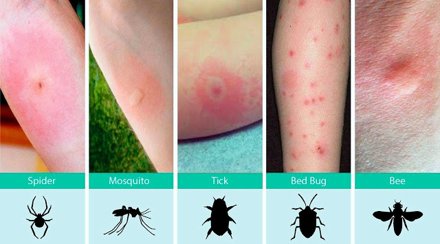picture of different types of insect bites found on your arm